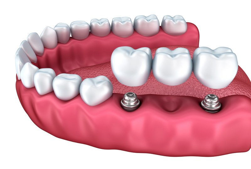 Treatment - Binley Woods Dentistry