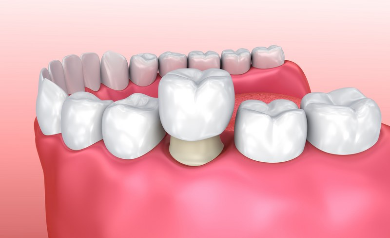 Treatment - Binley Woods Dentistry