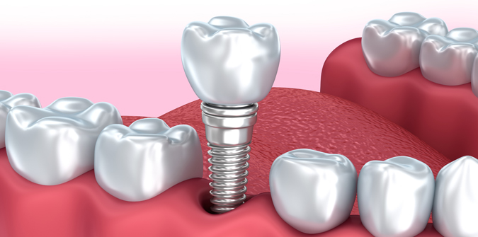 Binley Woods Dentistry